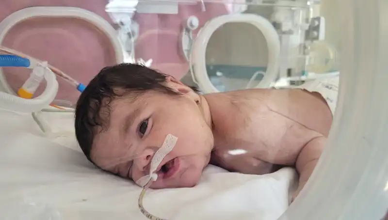 Dünyada 7. Kez Görülen Durum: 34 Haftalık Eymen Bebek İle İlgili Şaşırtan Gelişme