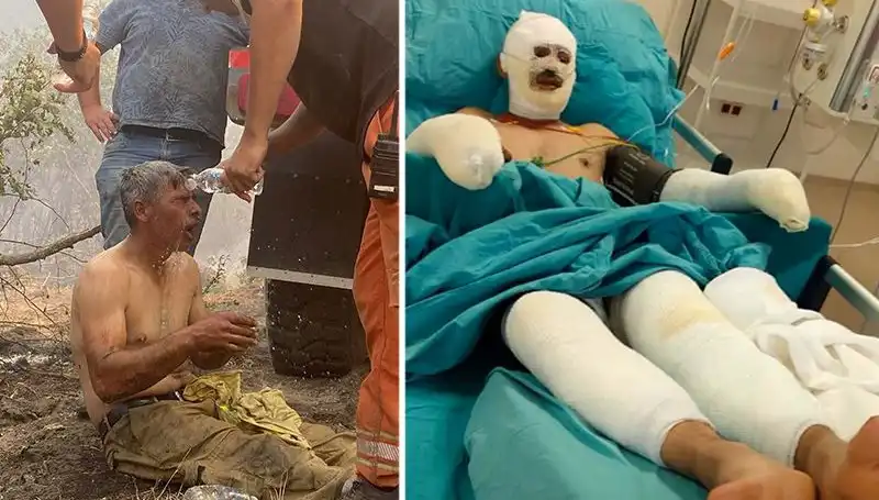 Yanıyorum Diye Feryat Etti, Orman İşçisinin Sağlık Durumu Merak Ediliyor